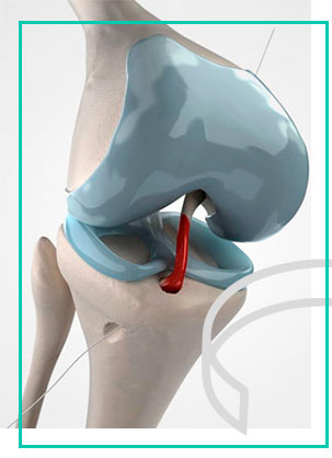 ligamento2