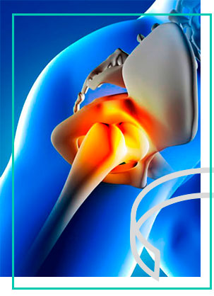 osteonecrose